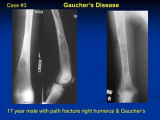 Case #3                Gaucher’s Disease




17 year male with path fracture right humerus & Gaucher’s
 