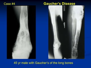 Case #4                    Gaucher’s Disease




      45 yr male with Gaucher’s of the long bones
 