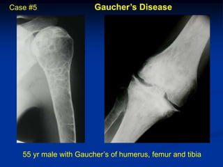 Case #5                 Gaucher’s Disease




   55 yr male with Gaucher’s of humerus, femur and tibia
 