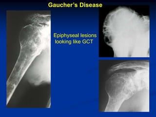 Gaucher’s Disease



 Epiphyseal lesions
 looking like GCT
 