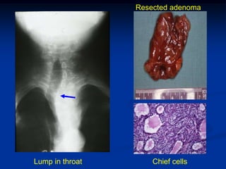 Resected adenoma




Lump in throat       Chief cells
 