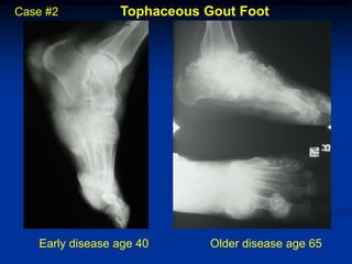 Case #2          Tophaceous Gout Foot




   Early disease age 40      Older disease age 65
 