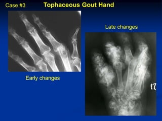 Case #3         Tophaceous Gout Hand


                                 Late changes




          Early changes
 