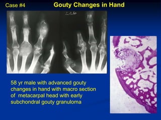 Case #4           Gouty Changes in Hand




 58 yr male with advanced gouty
 changes in hand with macro section
 of metacarpal head with early
 subchondral gouty granuloma
 