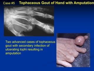 Case #5   Tophaceous Gout of Hand with Amputation




 Two advanced cases of tophaceous
 gout with secondary infection of
 ulcerating tophi resulting in
 amputation
 