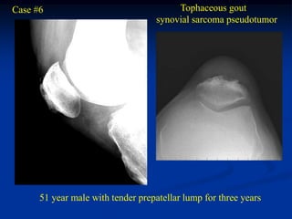 Case #6                                  Tophaceous gout
                                    synovial sarcoma pseudotumor




      51 year male with tender prepatellar lump for three years
 