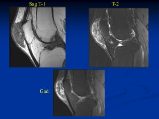 Sag T-1   T-2




    Gad
 