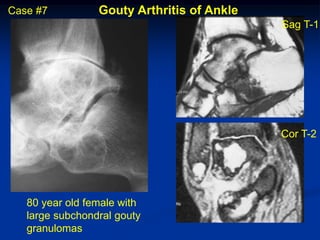 Case #7          Gouty Arthritis of Ankle
                                            Sag T-1




                                            Cor T-2




   80 year old female with
   large subchondral gouty
   granulomas
 