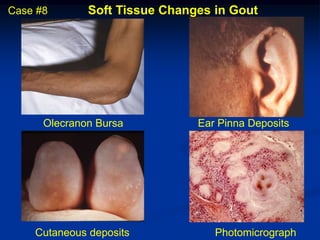 Case #8       Soft Tissue Changes in Gout




      Olecranon Bursa          Ear Pinna Deposits




    Cutaneous deposits            Photomicrograph
 