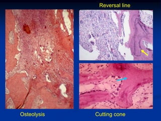 Reversal line




Osteolysis   Cutting cone
 
