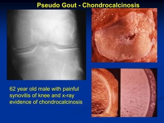 Pseudo Gout - Chondrocalcinosis




62 year old male with painful
synovitis of knee and x-ray
evidence of chondrocalcinosis
 