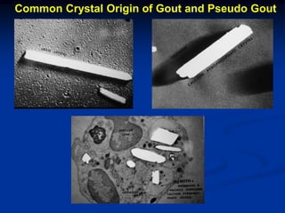 Common Crystal Origin of Gout and Pseudo Gout
 