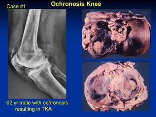 Case #1           Ochronosis Knee




62 yr male with ochronosis
    resulting in TKA
 