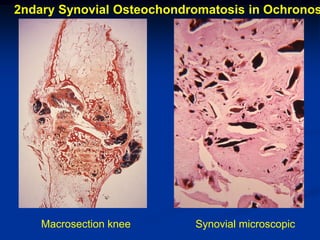 2ndary Synovial Osteochondromatosis in Ochronos




    Macrosection knee      Synovial microscopic
 