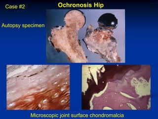Case #2              Ochronosis Hip


Autopsy specimen




           Microscopic joint surface chondromalcia
 