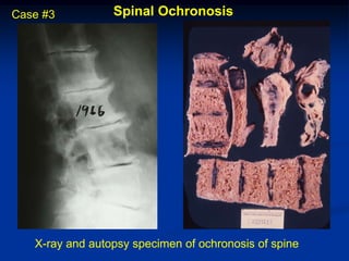 Case #3          Spinal Ochronosis




   X-ray and autopsy specimen of ochronosis of spine
 