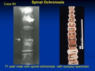 Case #4           Spinal Ochronosis




71 year male with spinal ochronosis with autopsy specimen
 