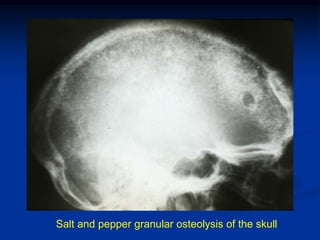 Salt and pepper granular osteolysis of the skull
 