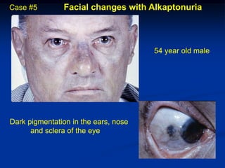 Case #5        Facial changes with Alkaptonuria



                                      54 year old male




Dark pigmentation in the ears, nose
      and sclera of the eye
 