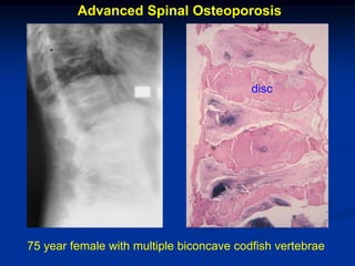 Advanced Spinal Osteoporosis




                                          disc




75 year female with multiple biconcave codfish vertebrae
 