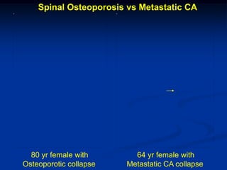 Spinal Osteoporosis vs Metastatic CA




  80 yr female with       64 yr female with
Osteoporotic collapse   Metastatic CA collapse
 