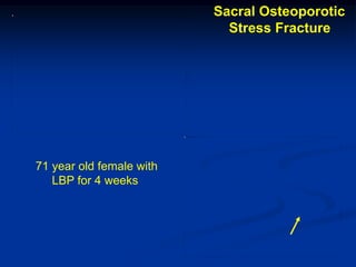 Sacral Osteoporotic
                            Stress Fracture




71 year old female with
   LBP for 4 weeks
 