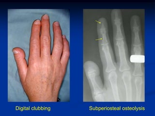 Digital clubbing   Subperiosteal osteolysis
 