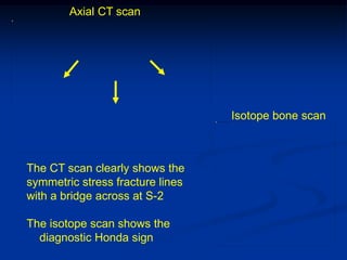 Axial CT scan




                                  Isotope bone scan



The CT scan clearly shows the
symmetric stress fracture lines
with a bridge across at S-2

The isotope scan shows the
  diagnostic Honda sign
 