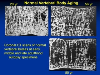 20 yr    Normal Vertebral Body Aging   56 yr




Coronal CT scans of normal
vertebral bodies at early,
middle and late adulthood
   autopsy specimens



                                80 yr
 