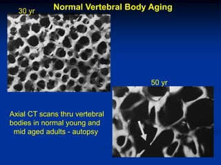 30 yr      Normal Vertebral Body Aging




                                   50 yr



Axial CT scans thru vertebral
bodies in normal young and
 mid aged adults - autopsy
 