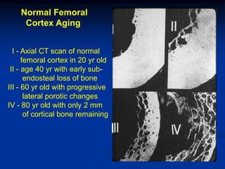 Normal Femoral
     Cortex Aging


  I - Axial CT scan of normal
      femoral cortex in 20 yr old
 II - age 40 yr with early sub-
       endosteal loss of bone
III - 60 yr old with progressive
       lateral porotic changes
IV - 80 yr old with only 2 mm
       of cortical bone remaining

                                    l
 