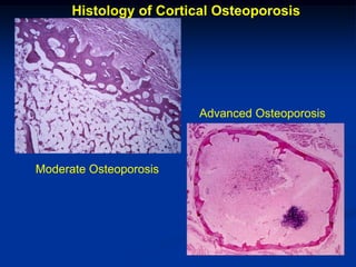 Histology of Cortical Osteoporosis




                        Advanced Osteoporosis



Moderate Osteoporosis
 