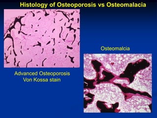 Histology of Osteoporosis vs Osteomalacia




                            Osteomalcia



Advanced Osteoporosis
   Von Kossa stain
 