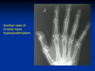 Another case of
of early hand
hyperparathroidism
 