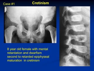 Case #1            Cretinism




  8 year old female with mental
  retardation and dwarfism
  second to retarded epiphyseal
  maturation in cretinism
 