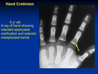 Hand Cretinism



       8 yr old
X-ray of hand showing
retarded epiphyseal
ossification and sclerotic
metaphyseal bands
 