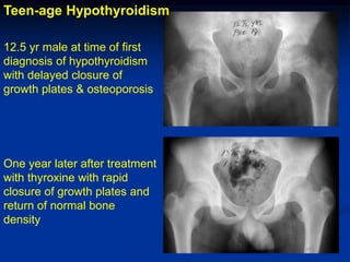 Teen-age Hypothyroidism

12.5 yr male at time of first
diagnosis of hypothyroidism
with delayed closure of
growth plates & osteoporosis




One year later after treatment
with thyroxine with rapid
closure of growth plates and
return of normal bone
density
 