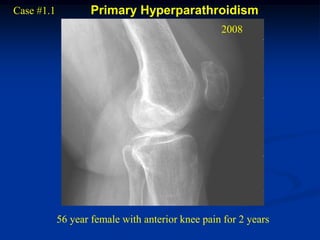 Case #1.1           Primary Hyperparathroidism
                                                  2008




            56 year female with anterior knee pain for 2 years
 