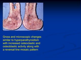 Gross and microscopic changes
similar to hyperparathyroidism
with increased osteoclastic and
osteoblastic activity along with
a reversal line mosaic pattern
 