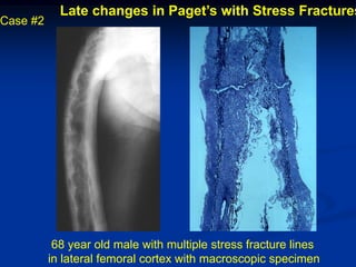 Late changes in Paget’s with Stress Fractures
Case #2




           68 year old male with multiple stress fracture lines
          in lateral femoral cortex with macroscopic specimen
 