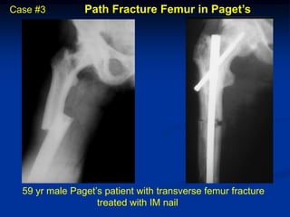 Case #3         Path Fracture Femur in Paget’s




  59 yr male Paget’s patient with transverse femur fracture
                   treated with IM nail
 