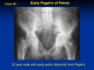 Case #5          Early Paget’s of Pelvis




    32 year male with early pelvic deformity from Paget’s
 