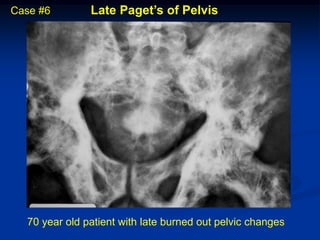 Case #6        Late Paget’s of Pelvis




  70 year old patient with late burned out pelvic changes
 