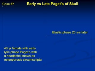 Case #7         Early vs Late Paget’s of Skull




                              Blastic phase 20 yrs later




 40 yr female with early
 lytic phase Paget’s with
 a headache known as
 osteoporosis circumscripta
 