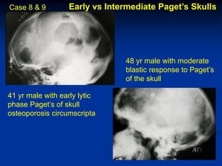 Case 8 & 9        Early vs Intermediate Paget’s Skulls




                               48 yr male with moderate
                               blastic response to Paget’s
                               of the skull

41 yr male with early lytic
phase Paget’s of skull
osteoporosis circumscripta
 