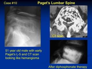 Case #10               Paget’s Lumbar Spine




                                CT scan



51 year old male with early
Paget’s L-5 and CT scan
looking like hemangioma

                              After diphosphonate therapy
 
