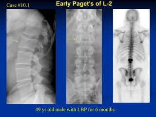 Case #10.1            Early Paget’s of L-2




             49 yr old male with LBP for 6 months
 