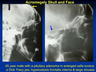 Acromegaly Skull and Face




45 year male with a pituitary adenoma in enlarged sella tursica
a Dick Tracy jaw, hyperostosis frontalis interna & large sinuses
 