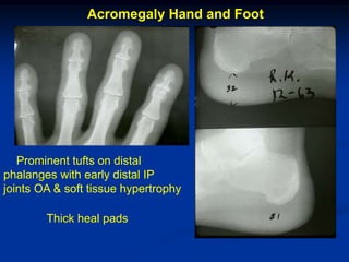 Acromegaly Hand and Foot




   Prominent tufts on distal
phalanges with early distal IP
joints OA & soft tissue hypertrophy

        Thick heal pads
 