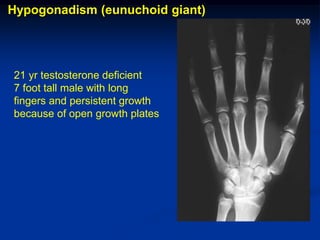Hypogonadism (eunuchoid giant)




21 yr testosterone deficient
7 foot tall male with long
fingers and persistent growth
because of open growth plates
 